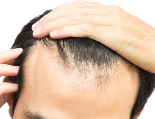 Male Hair Loss Prevention Treatments – An Overview