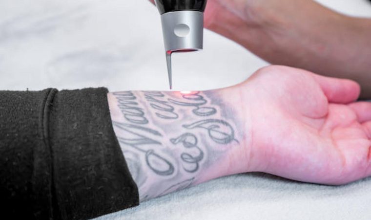 8 Tips To Speed Up Your Tattoo Removal Journey