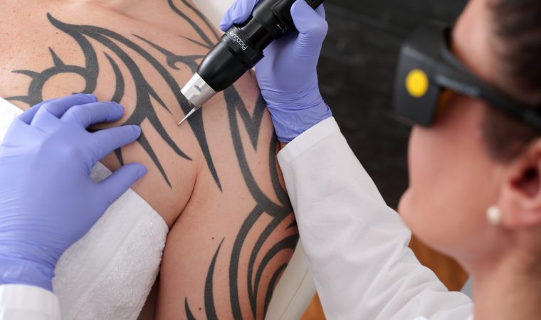 Five Tips For Choosing The Right Laser Tattoo Removal Service